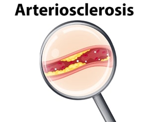 601 Words You Need to Know to Pass Your Exam - Arteriosclerosis - Learn English Vocabulary in Context with Images at LELB Society